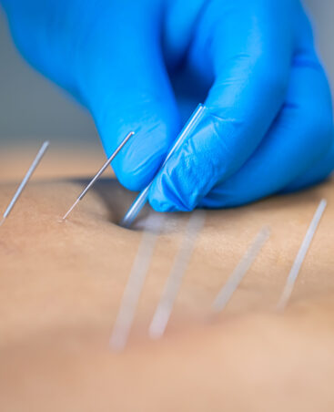 Dry Needling